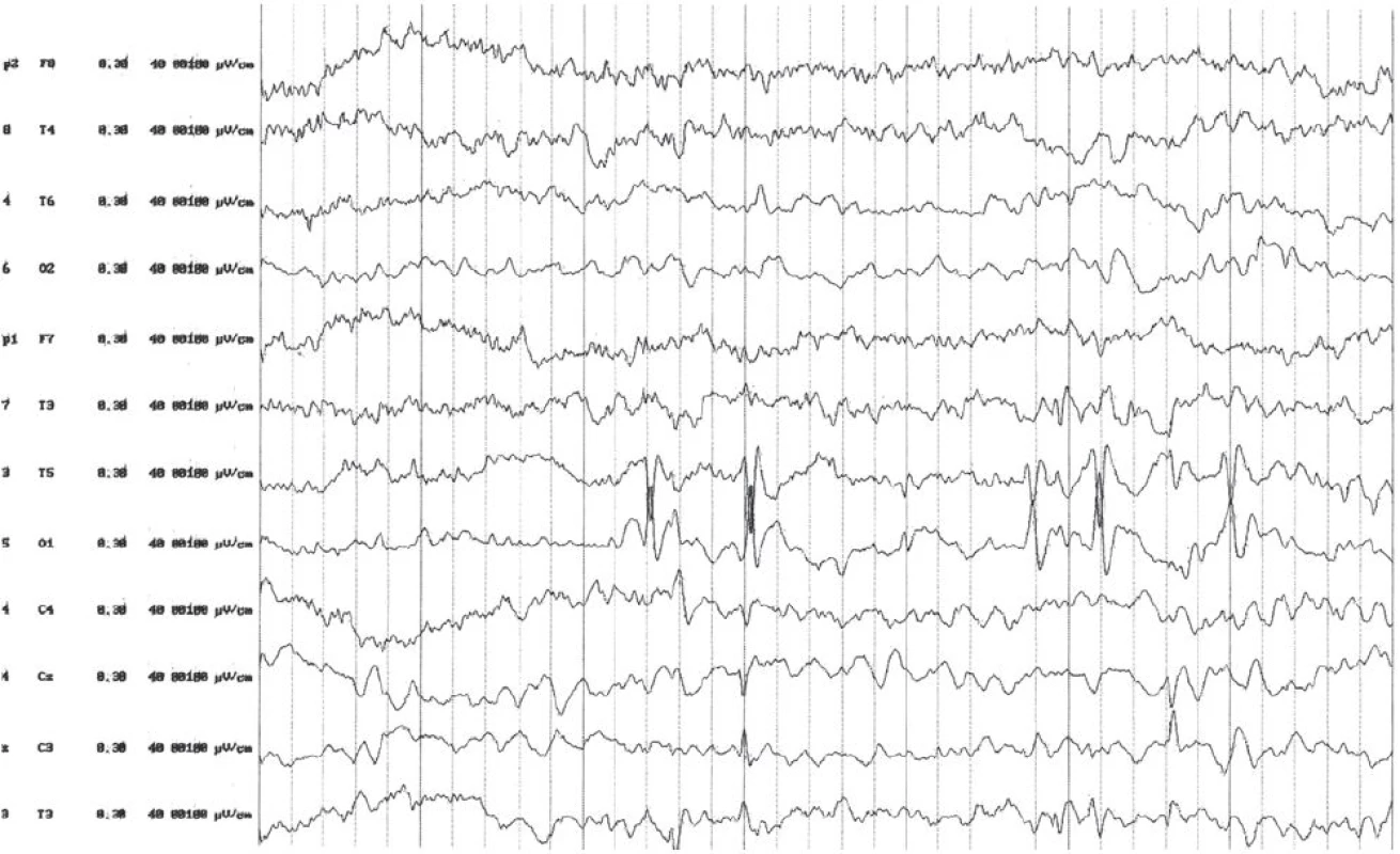 EEG pri liečbe ACTH. Výrazné zlepšenie spánkového EEG zápisu. Pretrváva ložisková epileptiformná aktivita temporálne vľavo s vymiznutím generalizácie.