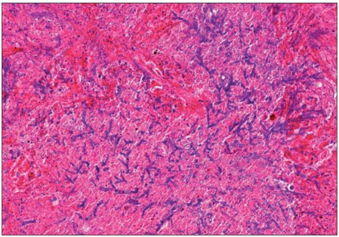 Histopatologický obraz plicní formy invazivní mykotické infekce.
Aspergillus ve formě větvících se vláken v terénu hemoragicko-nekrotizující pneumonie (hematoxylin-eozin, zvětšení 300×).