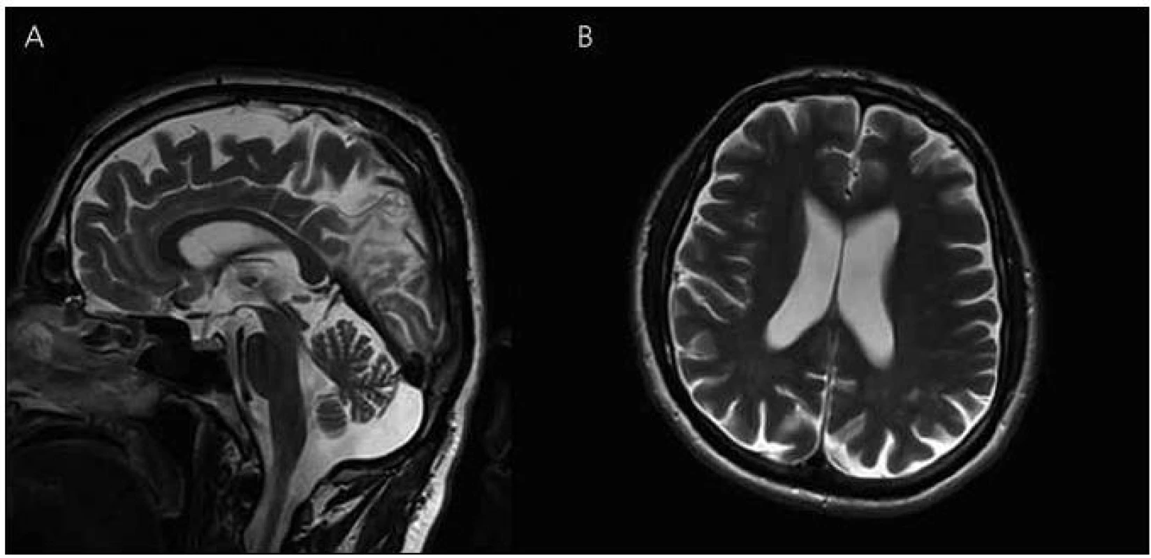 Magnetická rezonance mozku pacienta IV-4.
Atrofie mozku, megacisterna magna, průchodný mokovod a normální kmenové struktury v T2 vážených obrazech – rok 2008 (A) sagitální řezy (B) transverzální řezy.