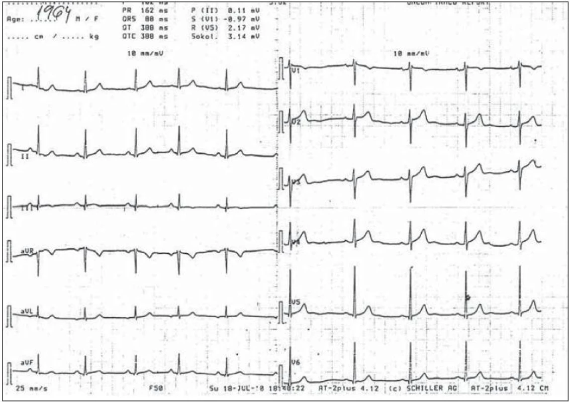 Aktuálny EKG záznam uvedeného pacienta, srdečná frekvencia (SF) = 60 (t.j. na dolnej hranici normy).