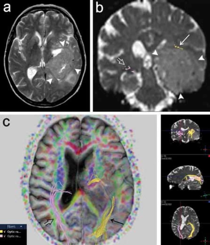 Pacientka s tumorózní expanzí vlevo (gliom gr. III), u níž bylo provedeno předoperační DTI vyšetření za účelem posouzení průběhu levostranné optické dráhy.
a) T2 vážený obraz v axiální rovině, tumor má intenzity signálu blízké šedé hmotě mozku (plné šipky).
b) Rekonstrukce obou optických drah na průřezu v koronární rovině. Vlevo je dobře patrno odtlačení dráhy kraniálně (šipka), vpravo optická radiace v obvyklém průběhu (otevřená šipka).
c) Projekce obou optických drah v různých rovinách, vlevo je zřetelné odtlačení dráhy.
