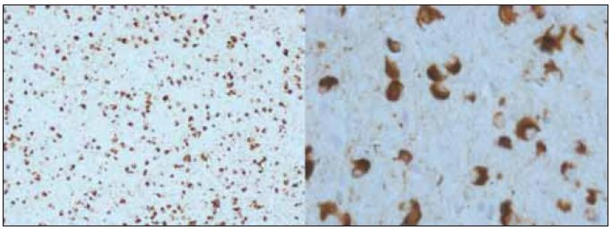 Alfa-synukleinopatie s argyrofilními oligodendrogliálními cytoplazmatickými inkluzemi, patologický obraz přiřazovaný k fenotypu multisystémové atrofie (zvětšení 100× a 400×).
&lt;sup&gt;©&lt;/sup&gt;Ústav patologie LF UP a FN Olomouc