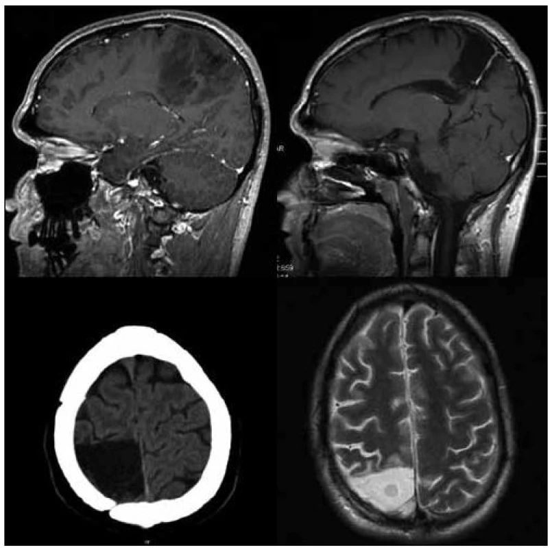 29letý pacient po radikální &gt; 90% resekci oligodendrogliomu gr. II v oblasti gyrus postcentralis, lobulus parietalis superior a corpus callosum vpravo v roce 2006.
