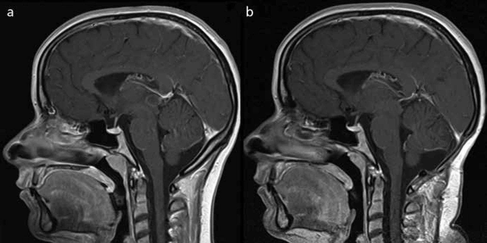 Pacientka 2 před a po operaci (MRI-T2 sekvence s kontrastem).
