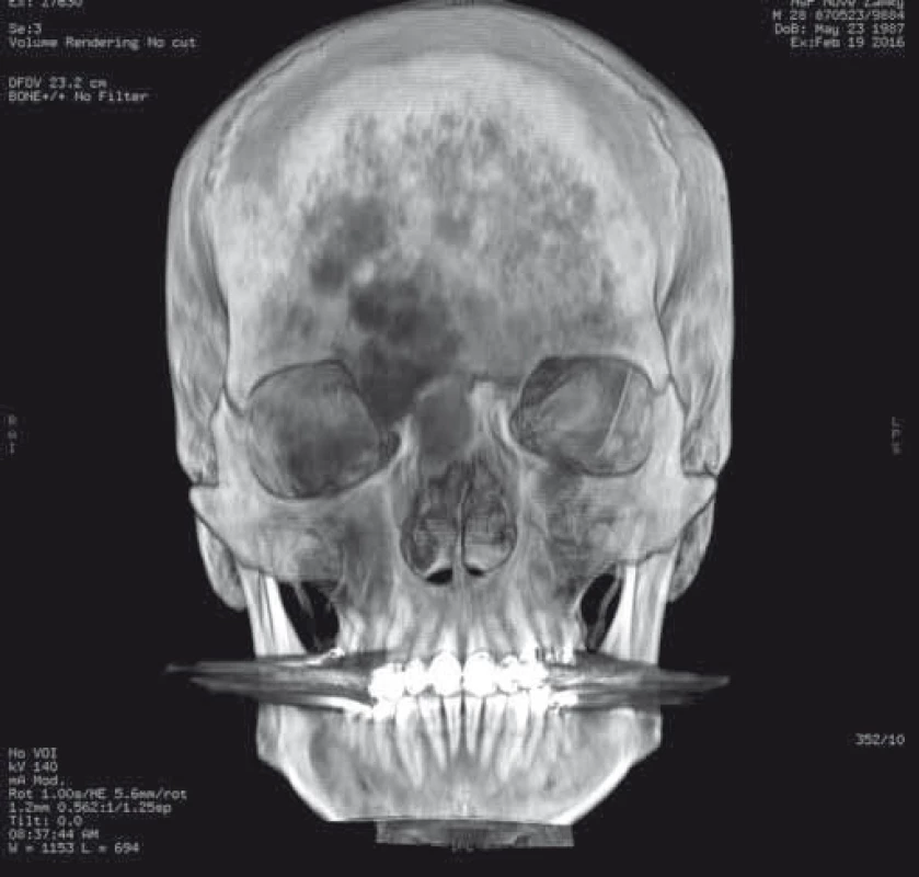 3D CT rekonštrukcia s použitím filtra na zvýraznenie nádorom postihnutých kostných štruktúr s postihnutím oboch frontálnych kostí až po okraj orbity, dorzálne takmer až po koronárny šev 
a laterálne až po fronto-zygomatické spojenie, mediálnej plochy pravej orbity a koreňa nosa.
Fig. 4. A 3D CT reconstruction image with a filter to enhance tumour-aff ected bone tissue showing involvement of both frontal bones up to orbital margins, almost reaching the coronal suture dorsally and zygomaticofrontal junction, medial area of the right orbit and radix nasi laterally.