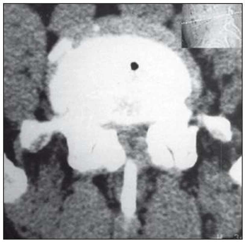 Axiální CT bederní páteře. Obraz sekundární stenózy páteřního kanálu.