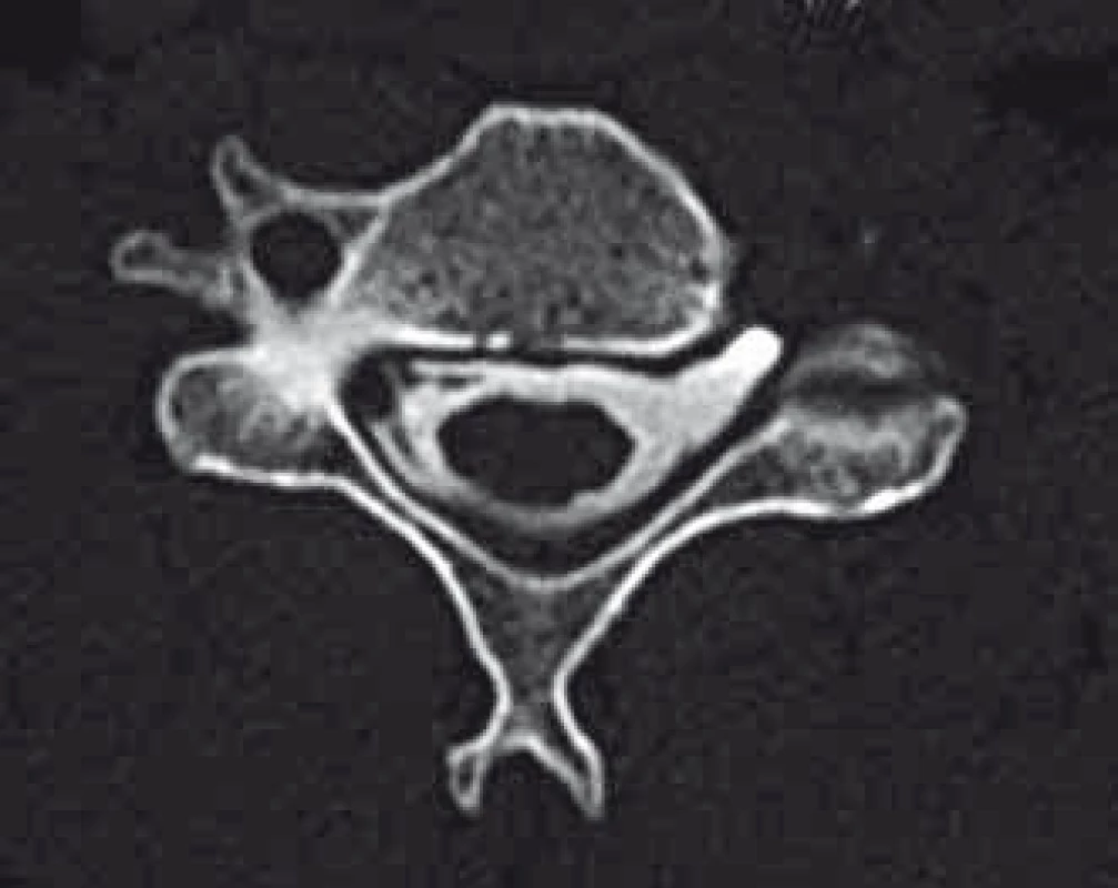 Příklad prokázané avulze kořene C5 vlevo dle CT myelografie (likvorová pseudocysta a chybějící ventrální i dorzální kořen vlevo).
Fig. 3. An example of confirmed root avulsion of C5 left on CT myelography (CSF pseudocyst and missing ventral and dorsal root left).