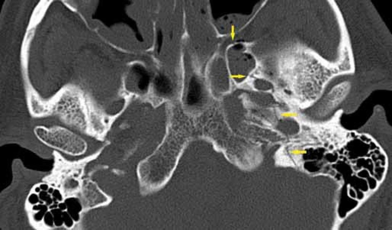 Petrózní fraktura bez postižení otické kapsuly, HRCT, axiální rovina.
Fig. 4. Petrous bone fracture without involvement of the otic capsule, HRCT, axial plane.