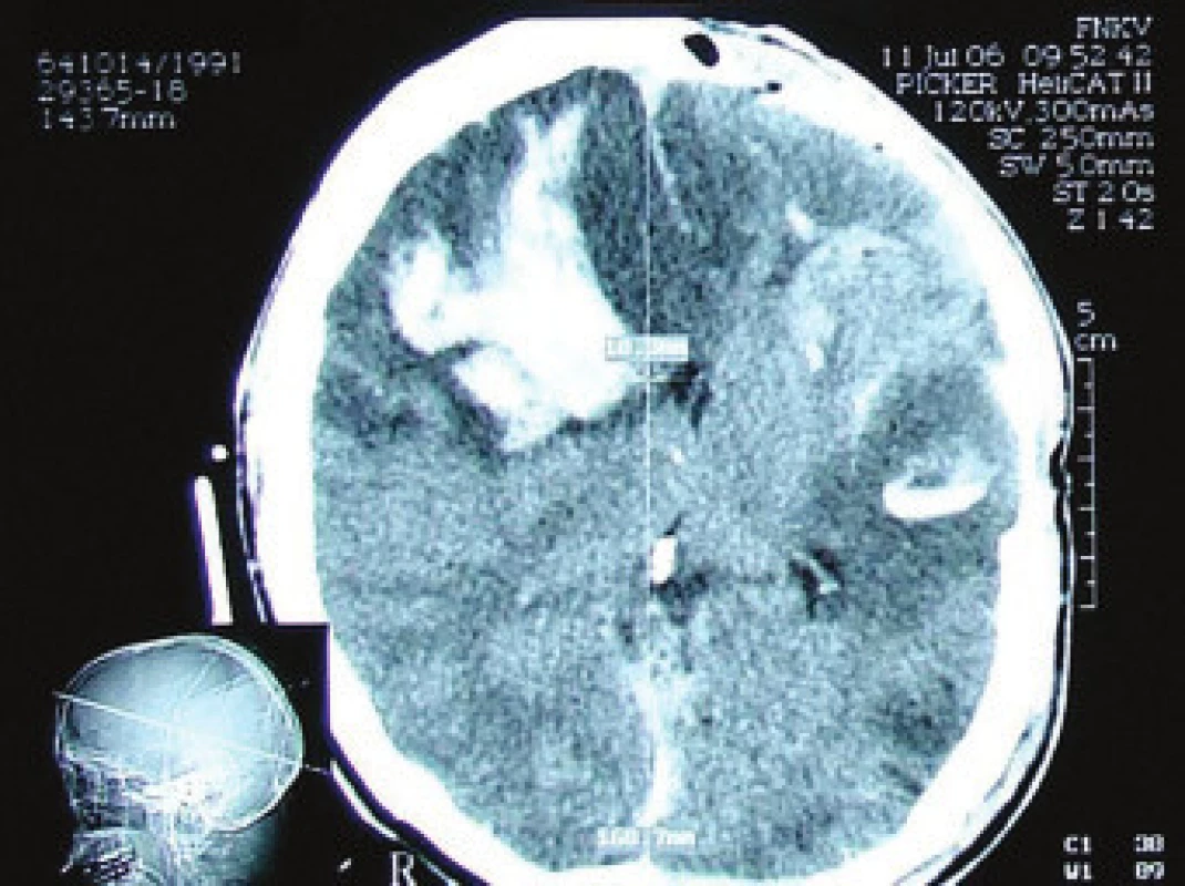 CT v mozkovém okně, dobarvení kontuze frontálně vpravo a temporálně vlevo, otok a hematom měkkých pokrývek lebních. Přetlak středočarových struktur o 10,3 mm.
