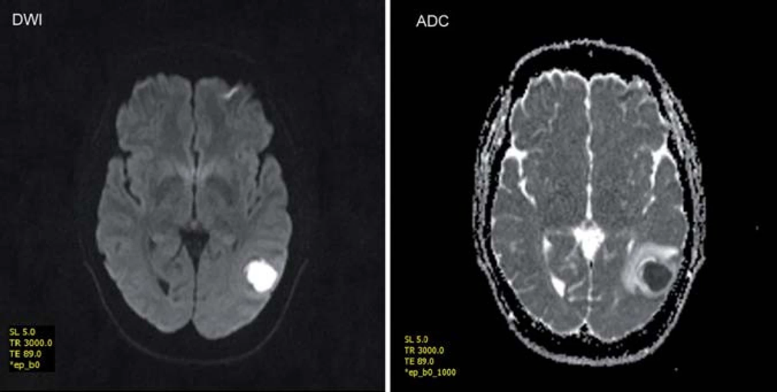 Zobrazení mozkového abscesu v difuzně váženém obraze (DWI) a zdánlivém koeficientu difuze (ADC) – vyšetření v poli 1,5T.
Fig. 2. Brain abscess in diffusion-weighted MRI (DVI) and apparent diffusion coefficient (ADC) – a 1.5 T examination.