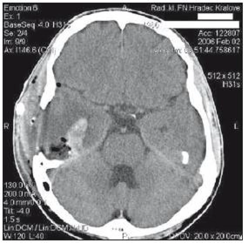 CT mozku z 2. února: pooperační stav – reziduum hematomu, mírný edém pravé hemisféry.