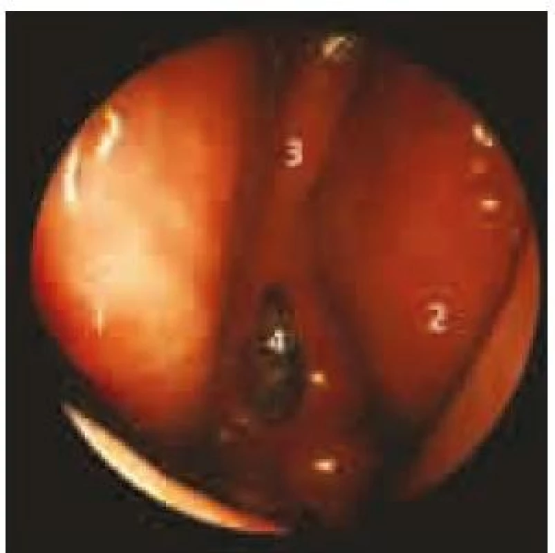 Endoskopický pohled do dutiny nosní čtyři týdny po transnazální exstirpaci adenomu hypofýzy.
1: střední skořepa vpravo, 2: střední skořepa vlevo, 3: septum nosní (část zadní části septa byla při operaci resekována), 4: otevřená klínová dutina