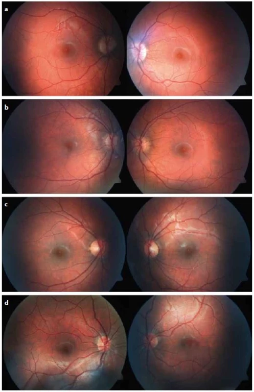 Biomikroskopický nález na očním pozadí fotograficky zdokumentovaný pomocí fundus kamery u čtyř dívek s poklesem zrakové ostrosti nejasné příčiny.