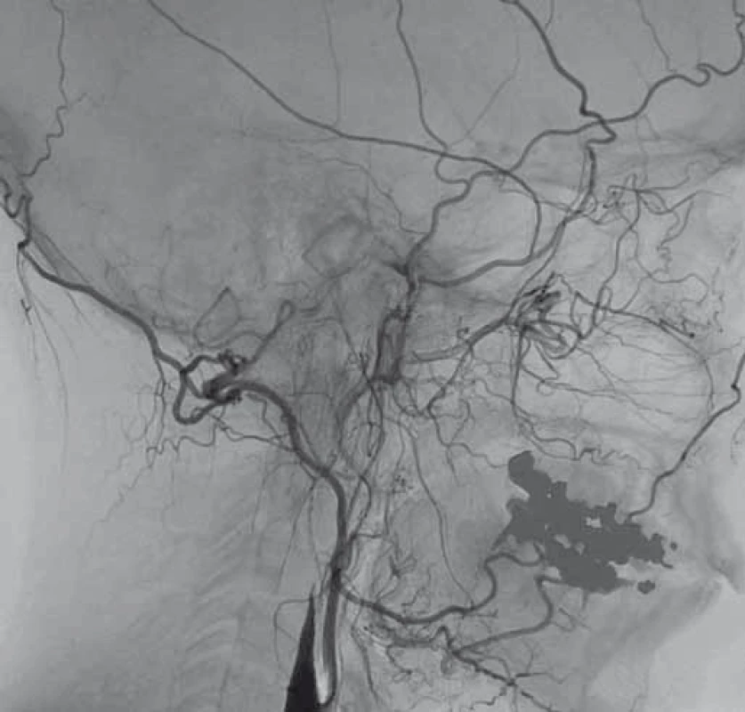 Digitální subtrakční angiografie.
Disekce levé a. carotis interna s její okluzí.
Fig. 1. Digital subtraction angiography.
Dissection of the left internal carotid artery with its occlusion.