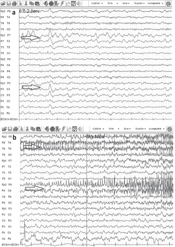 EEG u Rasmussenovej encefalitídy.
Obr. 3a) Polymorfná delta široko vľavo (šípky) pri normálnej základnej aktivite nad pravou hemisférou.
Obr. 3b) Epilepsia parcialis continua s difúznym spomalením široko vľavo, bez hrotov, nábor svalovej aktivity vpravo pri kontrakcii svalov periorbikulárne vpravo (šípky).
Fig. 3. EEG in Rasmussen’s encephalitis.
Fig. 3a) Polymorphic delta on the left (arrows), normal basal activity on the right.
Fig. 3b) Epilepsia parcialis continua with diffuse slowing on the left, no spiking, recruitment of muscle activity by contraction of right periorbicular muscles (arrows).