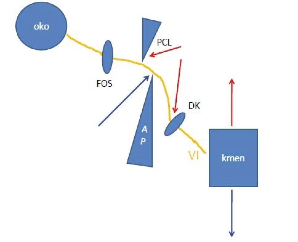 Schéma možností poškození nervus abducens při úrazu krční páteře během jeho průběhu. Červené šipky znázorňují hyperextenční poranění, modré šipky hyperflekční poranění. VI – nervus abducens; AP – apex pyramidy; DK – Dorellův kanál; FOS – fissura orbitalis superior, PCL – petroklinoidní ligamentum<br> Fig. 2. Diagram of possible damage of the abducens nerve during cervical spinal injury during its course. Red arrows show hyperextension injury, and blue arrows show hyperfl ective injury. VI – abducens nerve; AP – petrous apex; DK – Dorello´s canal; FOS – superior orbital fi ssure; PCL – petroclinoid ligament