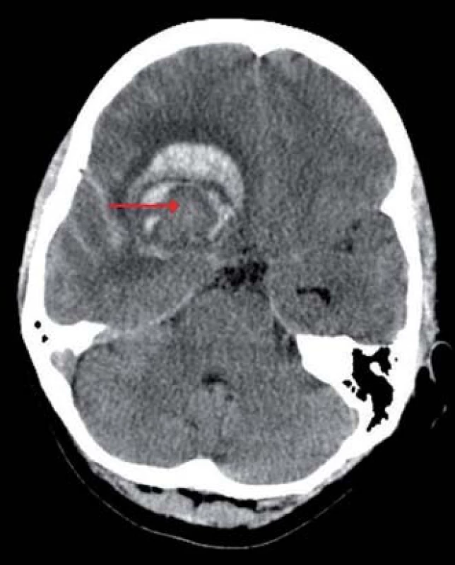 Výpočetní tomografie mozku, transverzální projekce, atypický nehomogenní intracerebrální hematom frontálně vpravo (červená šipka), subarachnoidální krvácení v oblasti pravé Sylvijské rýhy a mezi temporálními gyry.