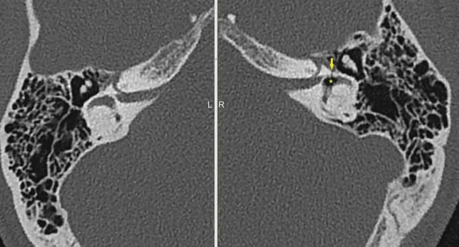 Petrózní fraktura s postižením otické kapsuly (*pneumovestibulum), HRCT, axiální rovina.
Fig. 3. Petrous bone fracture with involvement of the otic capsule (*pneumovestibule), HRCT, axial plane.