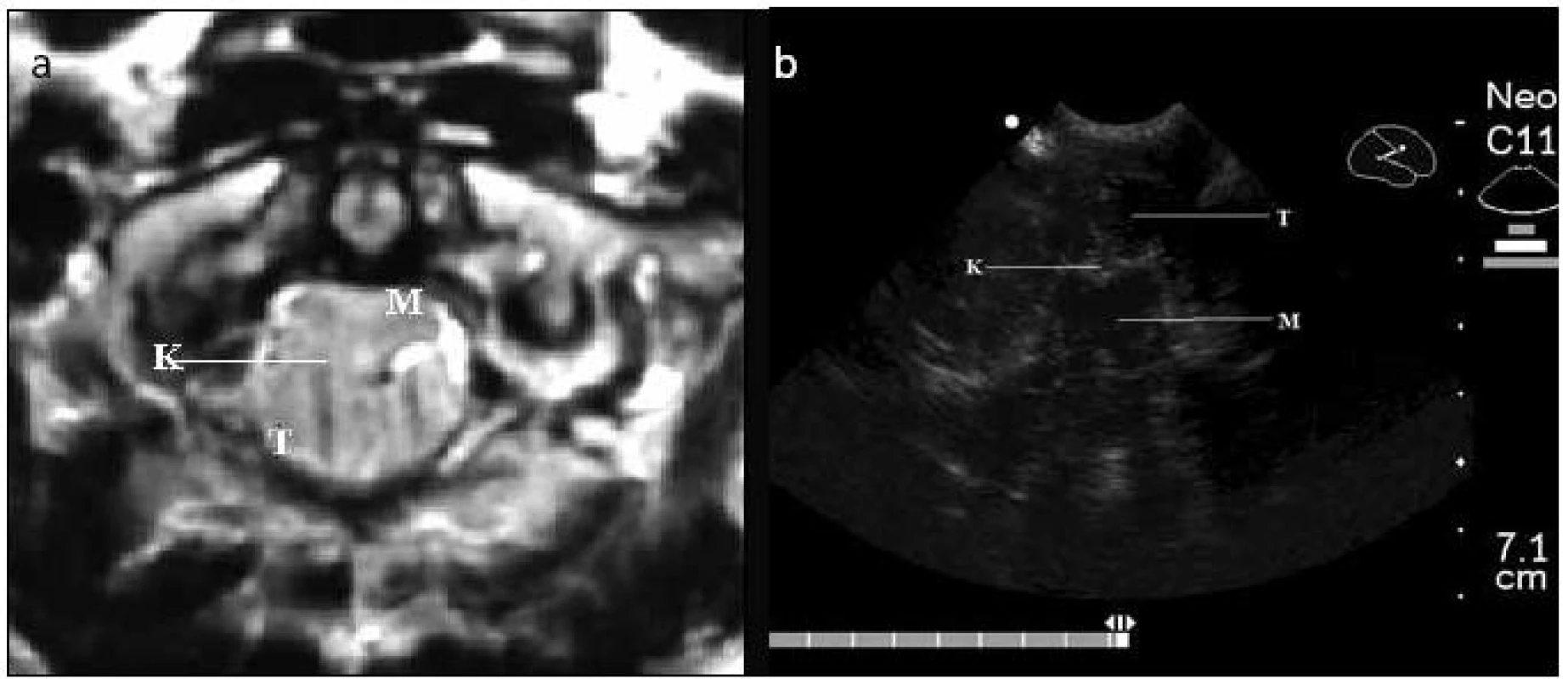 Chiariho malformace I typ A – předoperační MR T2, horizontální řez (2a) a peroperační ultrazvukové vyšetření v B obraze (2b).
T: mozečkové tonzily; M: mícha; K: místo komprese