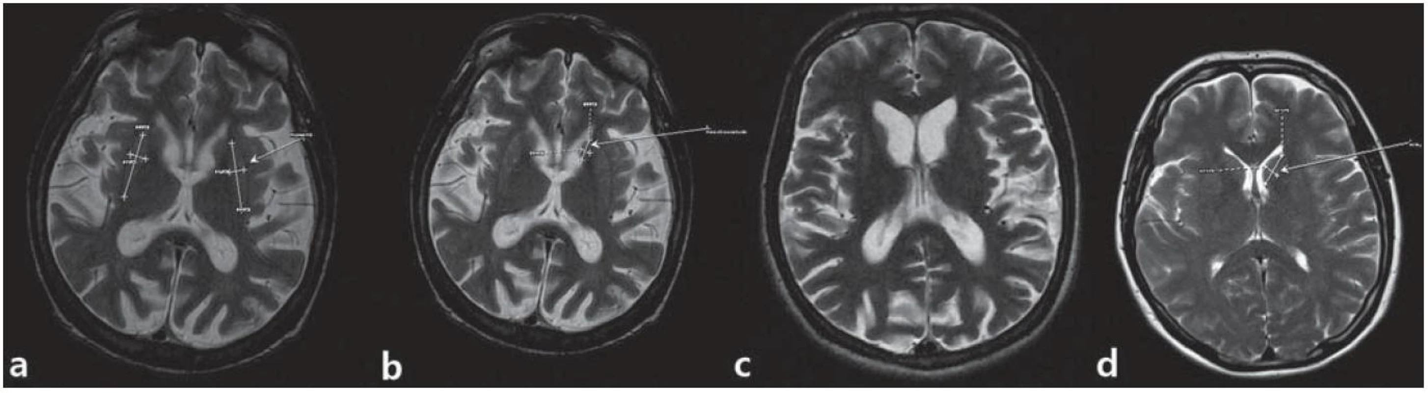 MR snímky mozgu pacienta z 1. kazuistiky.

a) postihnuté putamen, b) atrofické nucleus caudatum, c) dilatácia komorového systému a kortikálna atrofia, d) je na porovnanie ilustratívna snímka mozgu bez patologického nálezu. (Snímky získané v spolupráci s MUDr. M. Spurným, Novamed, Banská Bystrica.)