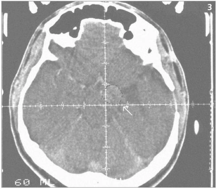 Hemangioblastom – centrační CT postkontrastní snímek před iradiací Leksellovým gama nožem (1993).
