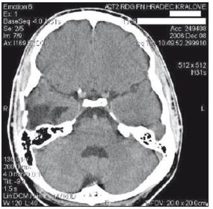 CT mozku z 1. prosince: rozlomení destičky Palacosu&lt;sup&gt;TM&lt;/sup&gt;, spodní část vpáčena do nitrolebí.

