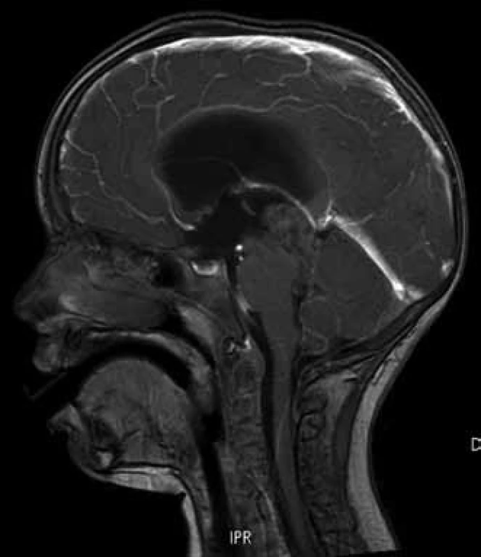 MR, T1, s kontrastem, sagitální řez, cystický a solidní tumor 3. a 4. mozkové komory, mírně nehomogenně se sytící po kontrastu.