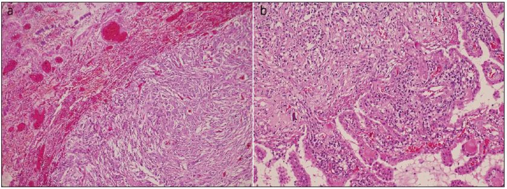 Překrvená plicní tkáň s ohraničenou metastázou anaplastického meningiomu, obdobného vzhledu jako ve vzorku z intrakrania (a). Struktury anaplastického meningeomu s buněčnou atypií, hyperchromasií a mitotickou aktivitou do 10 mitóz na 10 HPF, invadujícího do kalvy, kůže, fokálně nekrotizujícího (není zachyceno v řezu) a přecházejícího do papilární varianty (b).
Barvení hematoxylin eozinem.