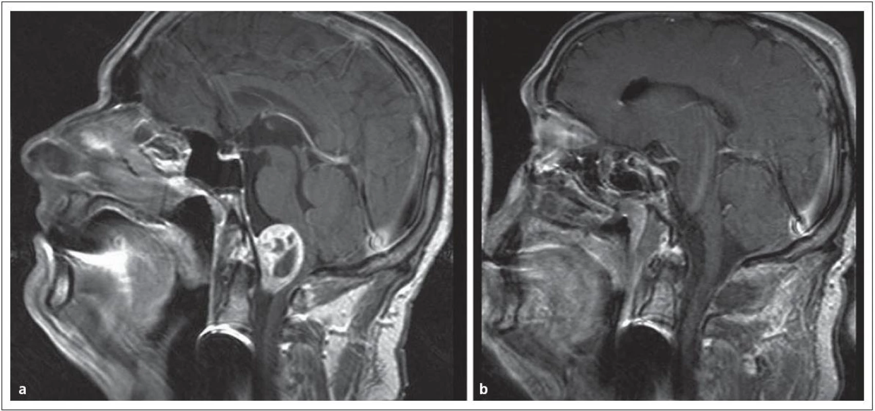 Meningeom v přední části foramen occipitale magnum.
Obr. 13a) V obraze MR před operací.
Obr. 13b) Po radikálním odstranění „far lateral přístupem“.