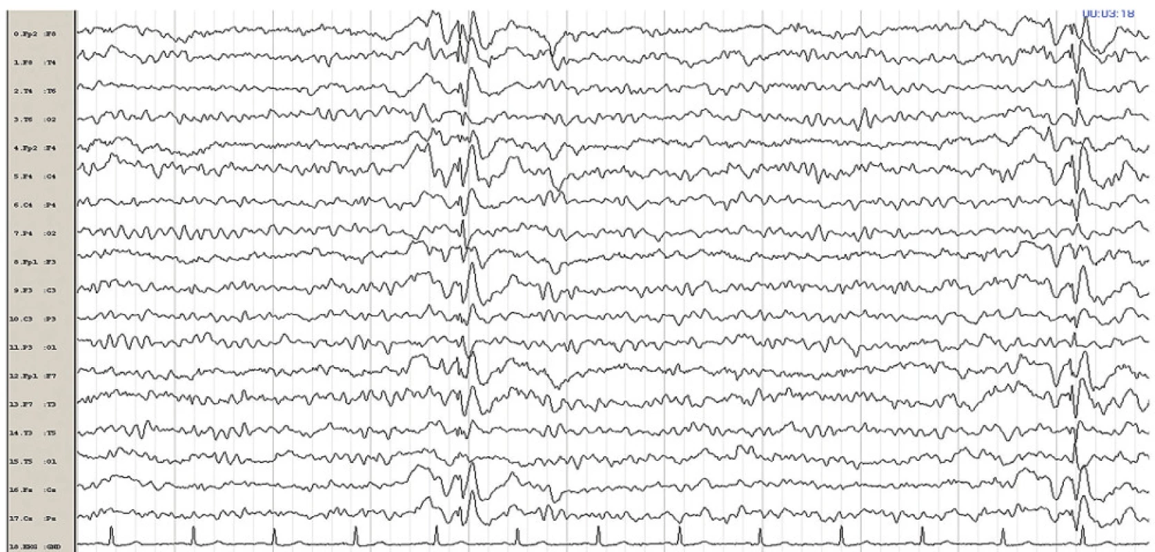 Kontrolní EEG po normalizaci klinického stavu po podání valproátu. Elektrografické projevy statu absencí mizí, ale jsou patrné epizody jednotlivých generalizovaných symetrických synchronních SW komplexů.