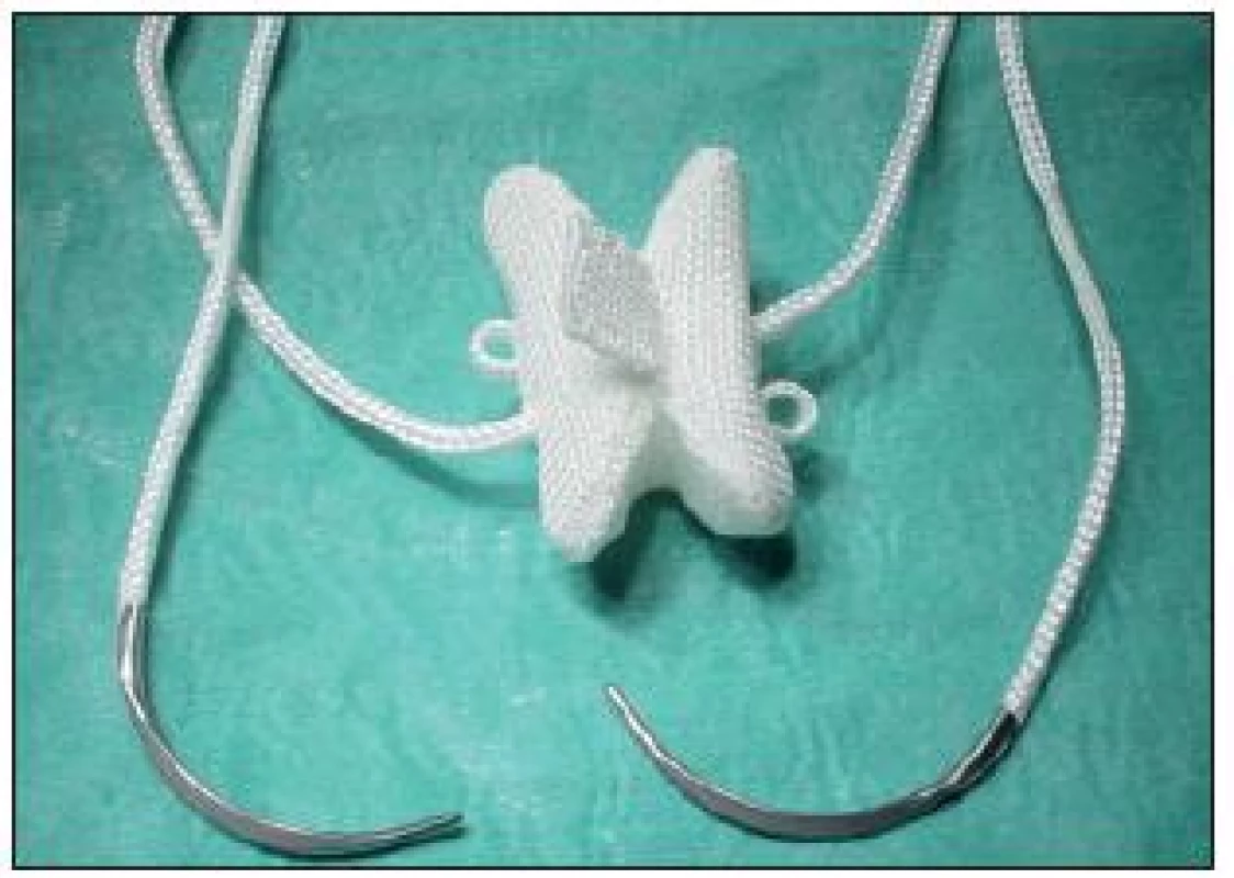 Implantát DIAM.
Motýlovitý tvar implantátu umožní stabilní pozici mezi spinózními výběžky obratlů. Po stranách jsou ouška a tkanice zakončené jehlou, které slouží k fixaci implantátu kolem horního a dolního spinózního výběžku.