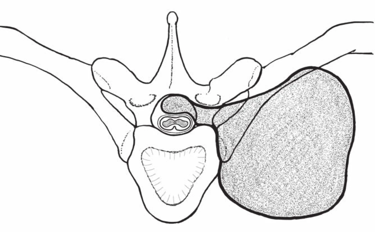 Nákres sutkovitého nádoru hrudní páteře, s extradurální lokalizací (axiální pohled).
Fig. 2. Drawing a dumbbell-shaped tumor of the thoracic spine, with extradural localization (axial view).