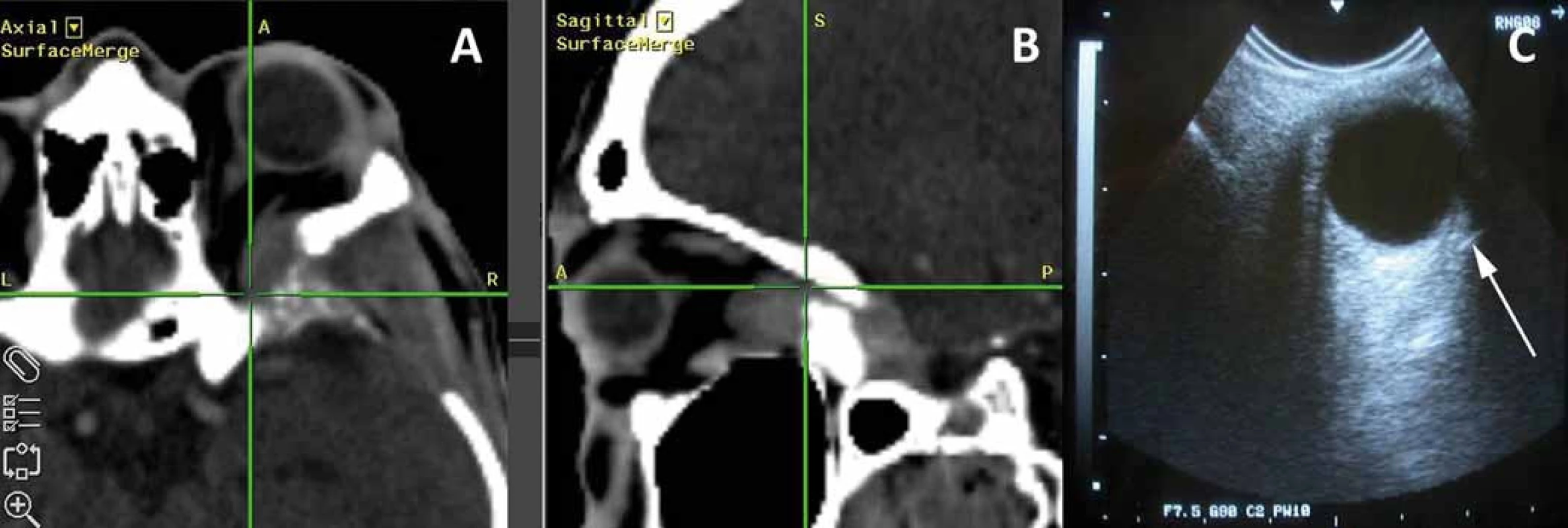 Intraoperační použití navigace u sphenoorbitálního meningeomu (A,B) a ultrazvukem navigovaná implantace transkonjunktivální elektrody do m. rectus lateralis pro EMG monitoraci n. abducens (C).