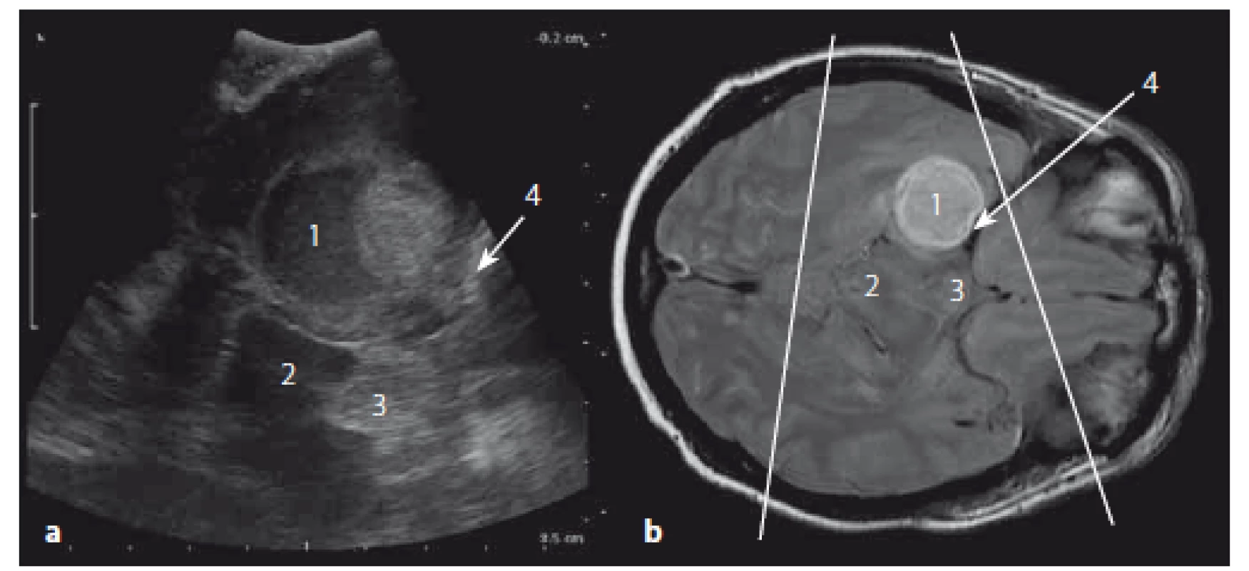 Absces temporálního laloku vpravo – sonografický a MR obraz.
Fig. 16. Abscess of the right temporal lobe – ultrasound and MR images.
