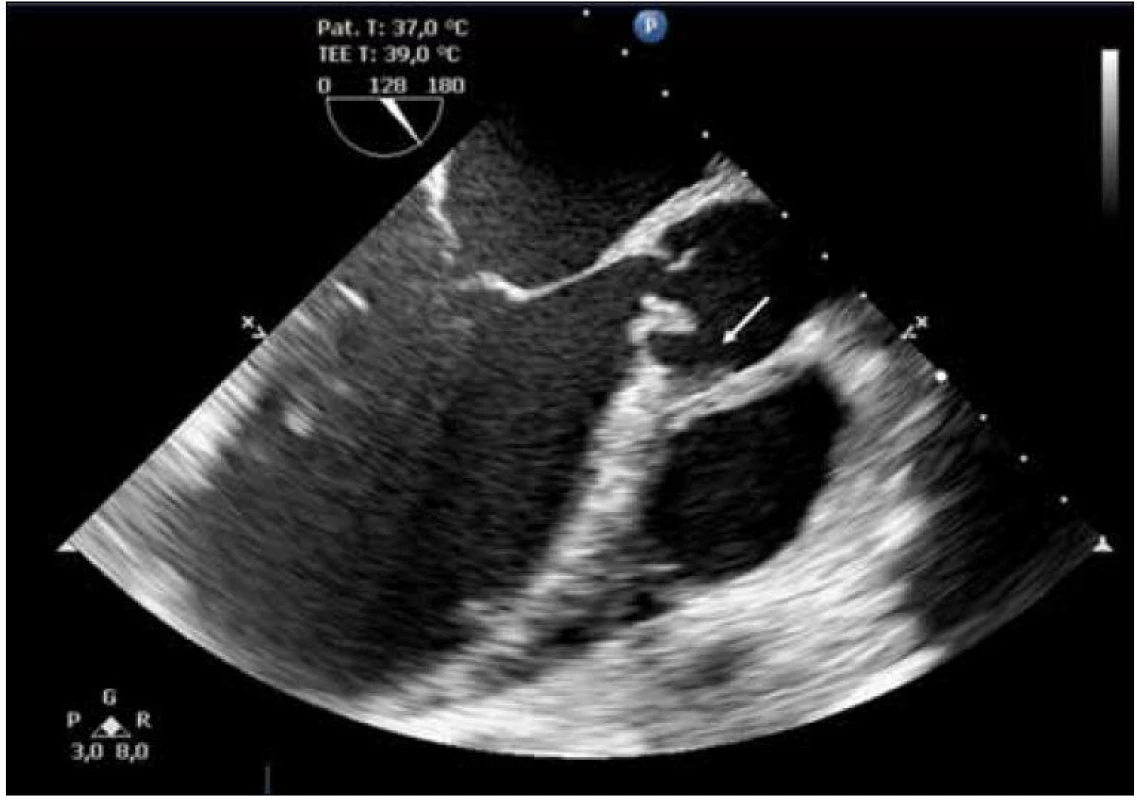 Transezofageální echokardiografické vyšetření, zobrazení aortálního kořene v dlouhé ose. Patrná destrukce aortální chlopně při infekční endokarditidě, odtržení úponu pravého koronárního cípu a promývaná abscesová dutina anulu.