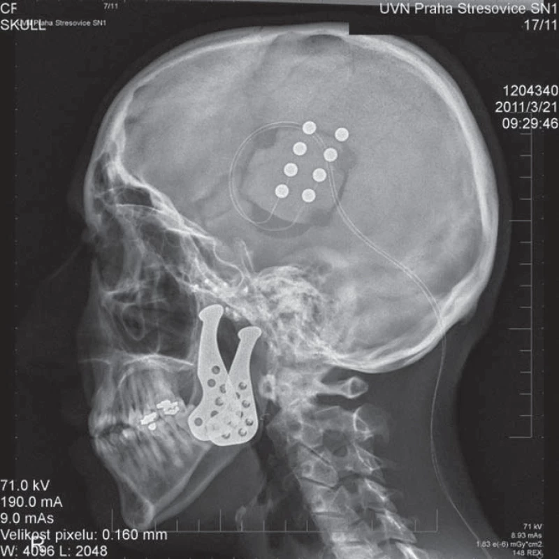 RTG snímek stimulace motorického kortexu u pacientky s pooperační neuropatickou bolestí obličeje.