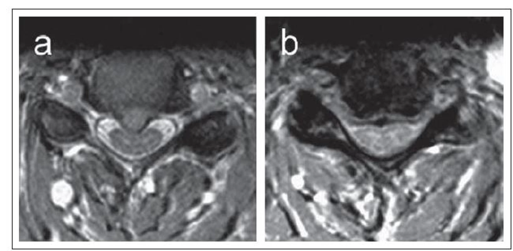 a,b) Axiální MR zobrazení dvou pacientů s cervikální spinální stenózou s odlišným typem míšní komprese.