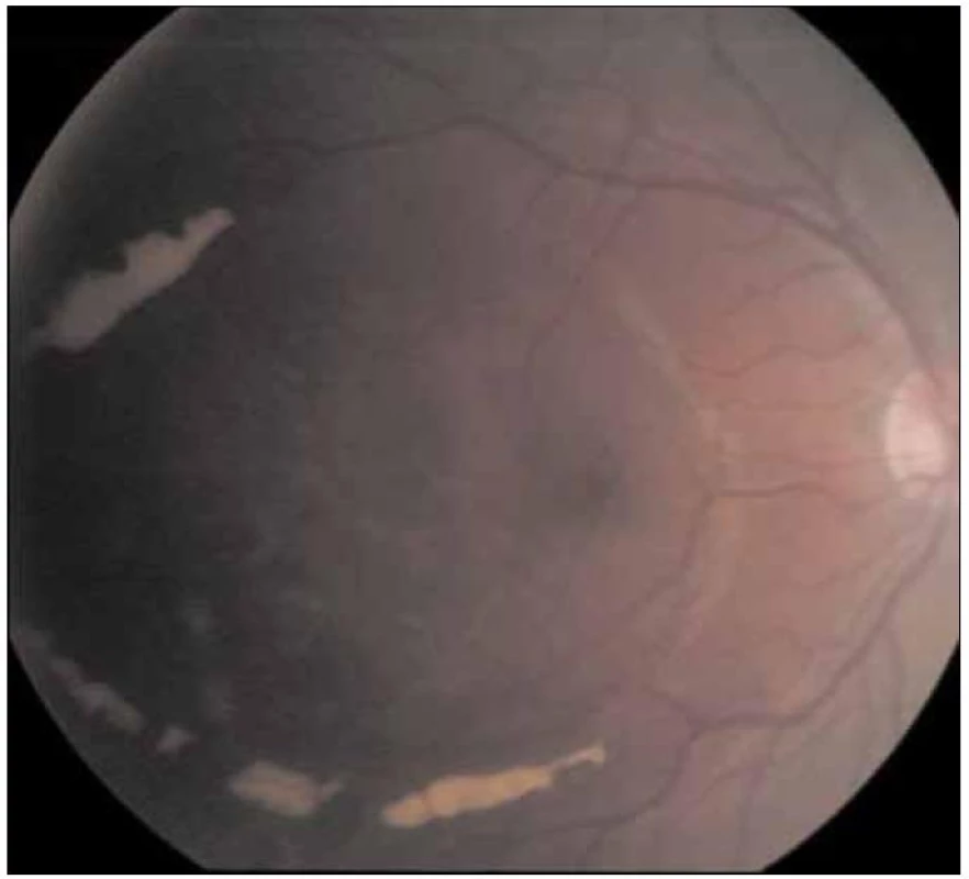 Ohraničená, bělavá depozita (rezidua po krvácení) demarkovala po pars plana vitrektomii pravého oka periferní hranici původního krvácení pod vnitřní limitující membránou sítnice oválného tvaru.