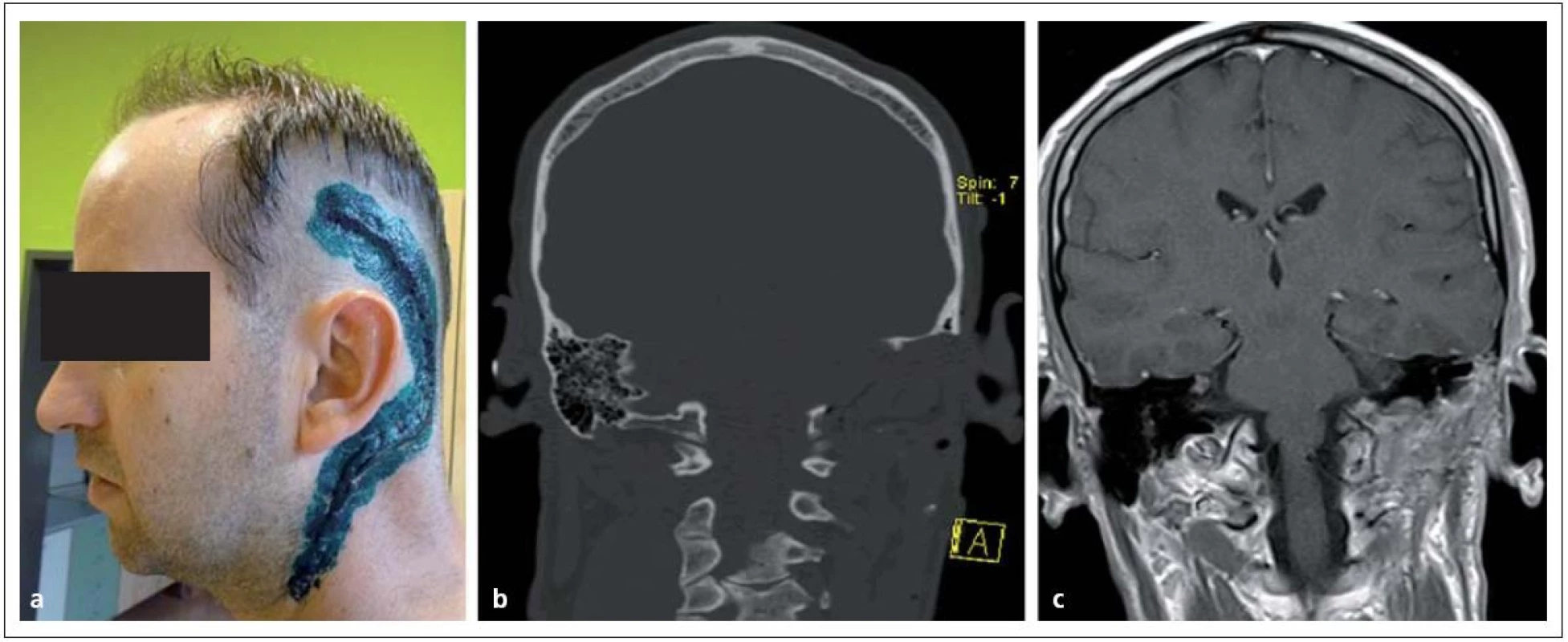 Glomus jugulare tumor po radikální resekci.
Obr. 11a) Rozsah operační rány.
Obr. 11b, c) Pooperační CT a MR bez rezidua nádoru.
