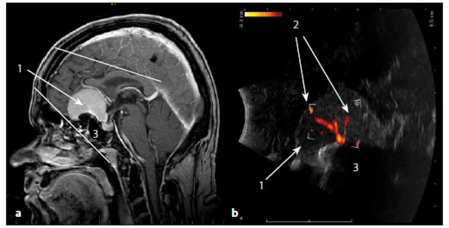 Sonografické duplexní zobrazení cévního zásobení meningeomu čichové rýhy.
Fig. 13. The ultrasound duplex image of arterial supply of olfactory meningioma.