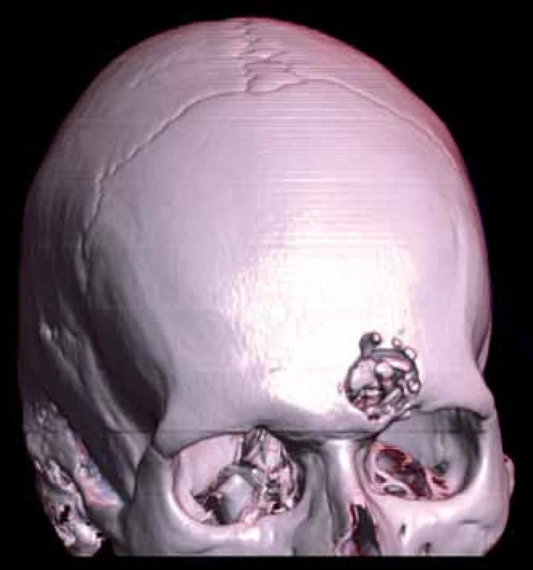 Otevřené penetrující poranění hlavy (3D).