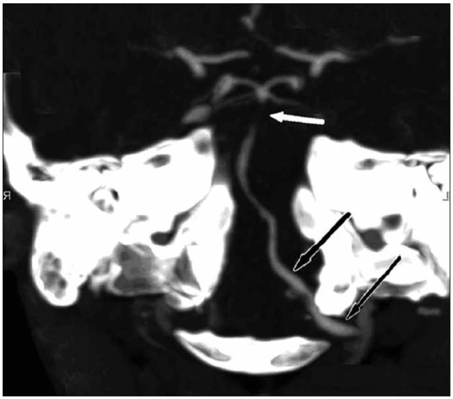 CT angiografie rekonstrukce vertebrobazilárního povodí.
Uzávěr střední části bazilární tepny (bílá šipka). Dominantní levá vertebrální tepna (černé šipky).