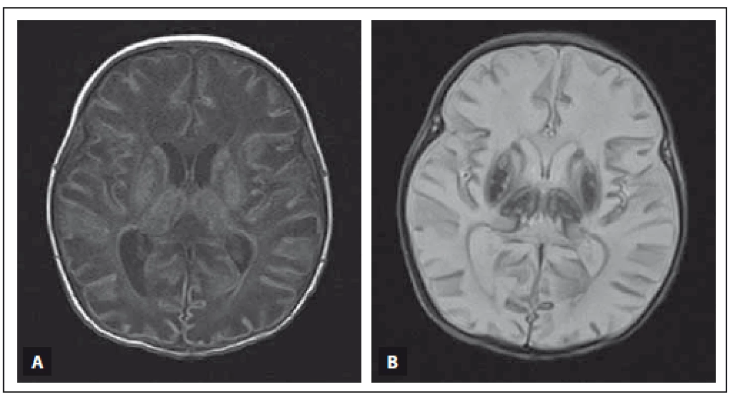 MR vyšetření mozku donošeného novorozence (chlapec, gestační věk 39 + 3), postižení bazálních ganglií, thalamů, zadního raménka capsula interna oboustranně, kůry a bílé hmoty difuzně při těžké HIE.
Fig. 4. MRI of a term-neonatal brain (boy, gestational age 39 + 3), pathological lesions in both basal ganglia, thalami, posterior limbs of the internal capsulae, cortex and white matter in a neonate with severe HIE.