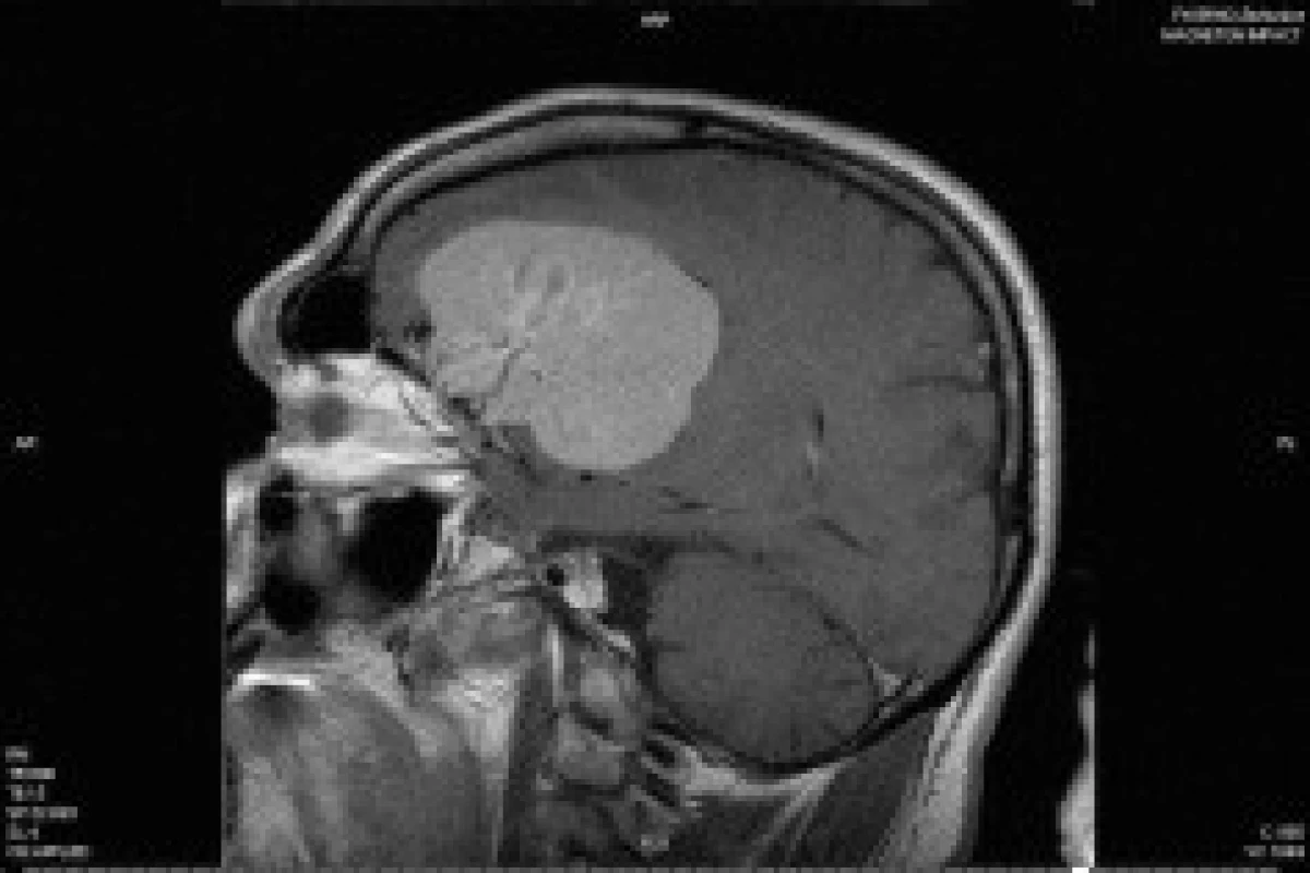 Snímek MRI; sagitální řez s nálezem tumoru vyrůstajícího z baze přední jámy lební s bohatým cévním zásobením.
