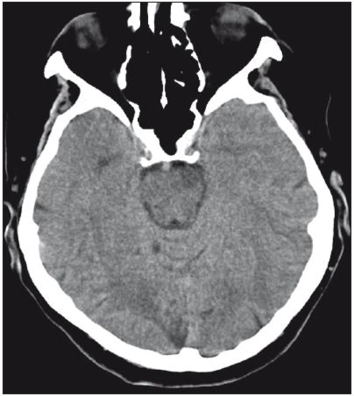 Kontrolní CT sken se zobrazením výsledné ischemické léze v oblasti pontu vlevo a v povodí kalkarinní větve zadní mozkové tepny vpravo.