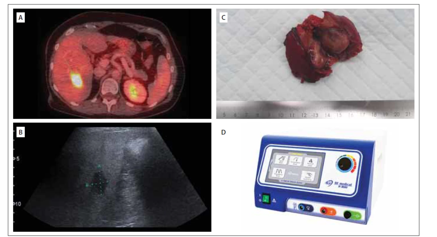 (A) Jaterní metastáza na PET CT (18FDG); (B) Peroperační ultrazvukové zobrazení jaterní metastázy; (C) Jaterní metastáza maligního
prolaktinomu; (D) RFA sonda užívaná na našem pracovišti<br>
FDG – fludeoxyglukóza; RFA – radiofrekvenční ablace<br>
Fig. 2. (A) Liver metastasis on PET/CT (18FDG); (B) Intraoperative ultrasound of the liver metastasis; (C) Liver metastasis of malignant prolactinoma;
(D) RFA probe used in our department<br>
FDG – fluorodeoxyglucose; RFA – radiofrequency ablation