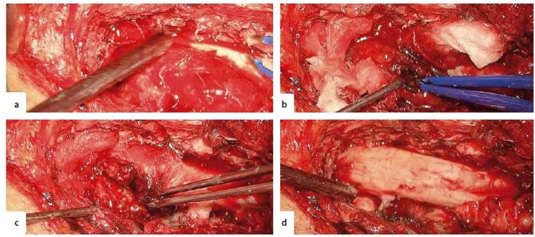 Intraoperative images. A – encapsulated, extramedullary tumour, B – fenestration in the tumour capsule, C – evacuation of an
intracapsular haematoma, D – final aspect with total resection of the tumour.