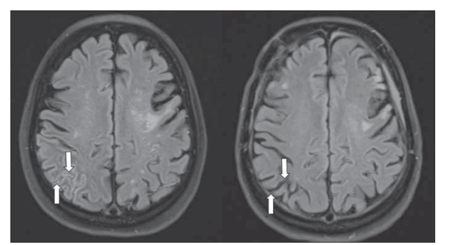 T2 FLAIR MR – (a) „ivy sign“ vpravo okcipitálně (šipky); (b) vymizení „ivy sign“ po
revaskularizaci.<br>
FLAIR – fl uid attenuated inversion recovery<br>
Fig. 4. T2 FLAIR MRI – (a) “ivy sign” in the right occipital region (arrows); (b) “ivy sign”
disappearence after revascularization.<br>
FLAIR – fl uid attenuated inversion recovery