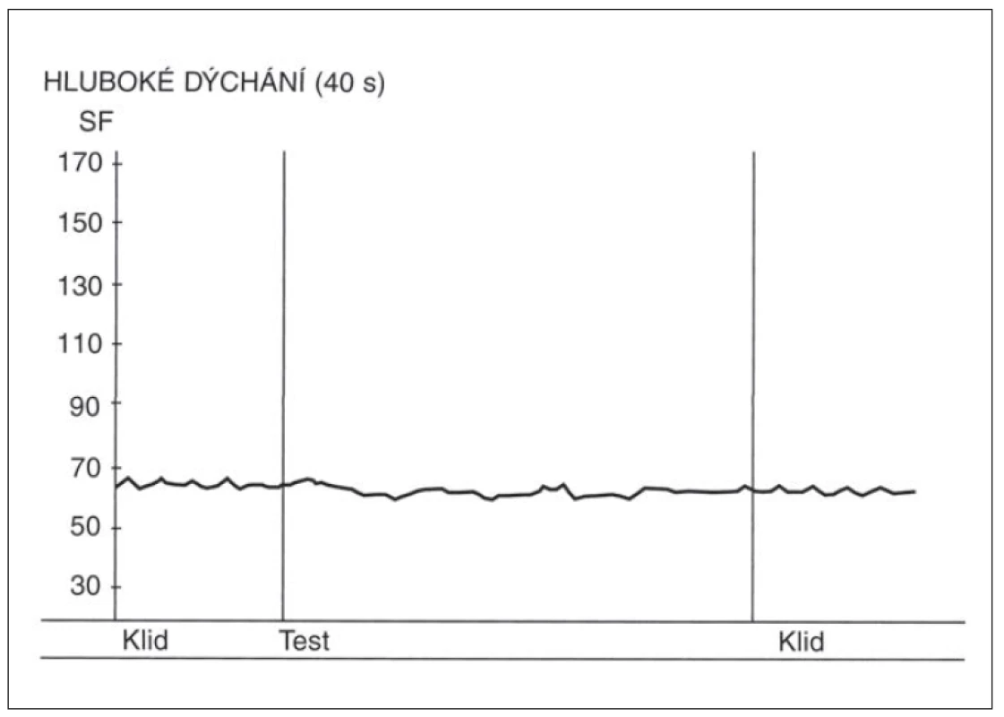 Změny srdeční frekvence (SF) ve zkoušce hlubokého dýchání u pacienta s těžkou
diabetickou autonomní neuropatií.
Nad osou x – křivka zobrazující změny srdeční frekvence ve zkoušce hlubokého dýchání.
Chybění respirační sinusové arytmie. Osa y – hodnoty srdeční tepové frekvence za minutu.<br>
Fig. 2. Heart rate (SF) changes during the deep breathing test in a patient with severe
diabetic autonomic neuropathy.
Above the x-axis – curve depicting heart rate changes during the deep breathing test.
Absence of respiratory sinus arrhythmia. Y-axis – heart rate (beats per minute).