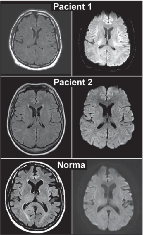  MR mozku pacientů s encefalopatií
a normální kontroly<br>
Fig. 1. MRI scans of encephalopathic
patients and normal control. 